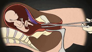 25岁的女生有几次打胎,女子堕胎6次连医生都惊讶了