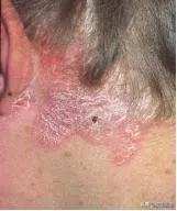 浑身瘙痒有很多皮屑,浑身瘙痒起鸡皮疙瘩怎么回事