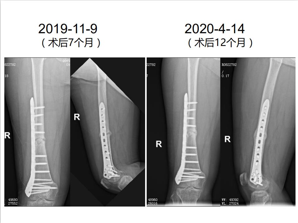 平乐骨科推拿教学,中医治疗骨折畸形愈合