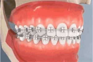 初戴牙套吃什么食物,单颗牙戴牙套怎么固定