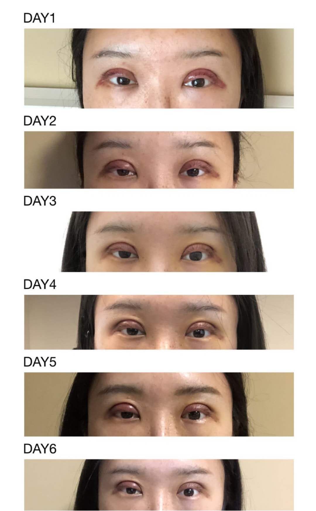 双眼皮前宽后窄算失败吗,双眼皮手术宽度是指恢复后吗