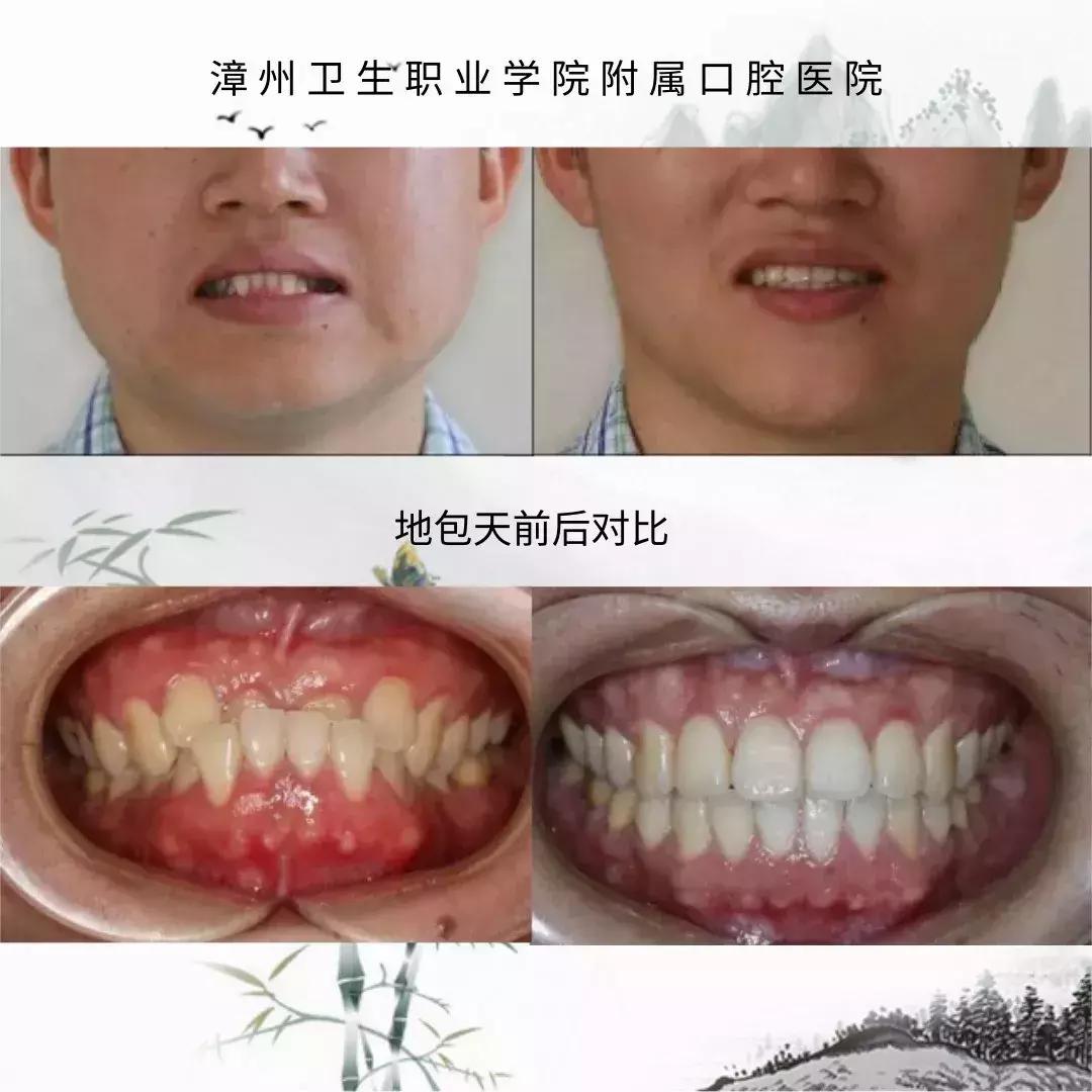 什么叫地包天怎么治疗,什么叫地包天能矫正吗