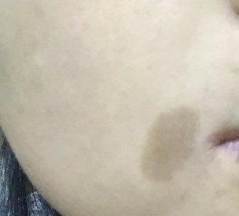 脸上各种斑图解,脸上常见6种斑点图片