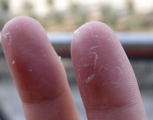 7岁孩子手指上换季脱皮,手指脱皮是身体求救信号