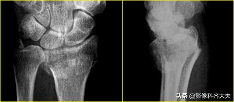 骨折的影像学检查及各自的优势,骨折的影像学愈合标准