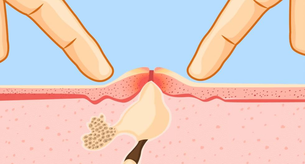 痘痘、闭口反反复复?搞定痘痘,这6种药不能少