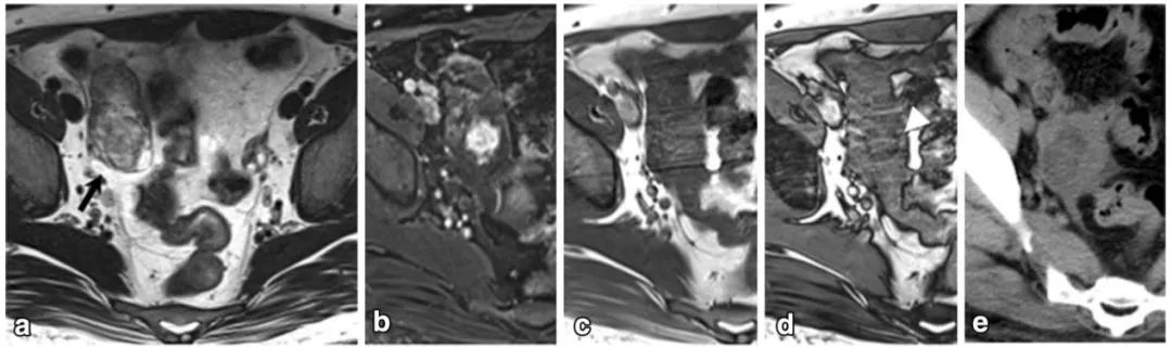 卵巢实性为主肿瘤，这13种你都想到了吗？