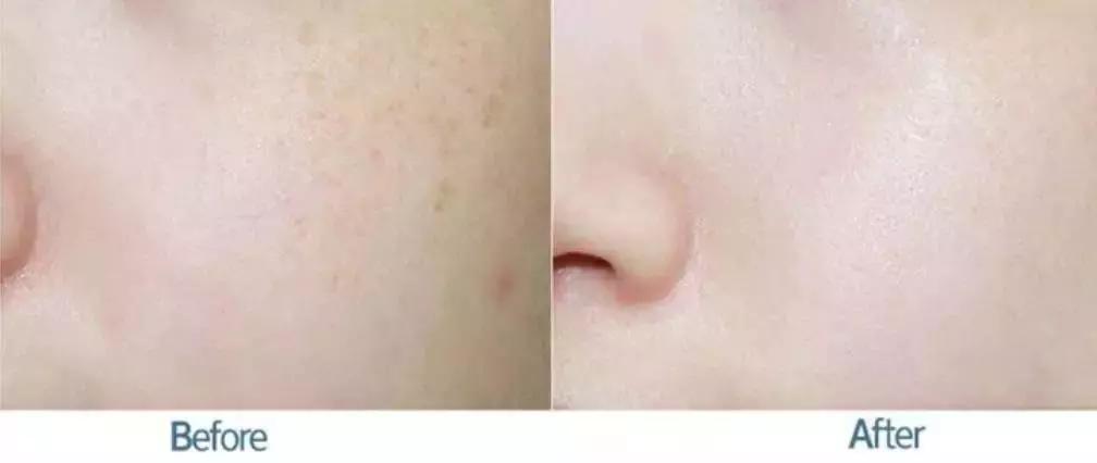 祛色斑的小窍门,色斑严重学会这几招省钱又有效