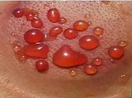 一看就会手把手教拔罐疗法,学拔罐视频教程全集