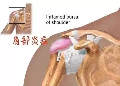 卧推肩膀疼怎么缓解,卧推肩膀疼如何做康复