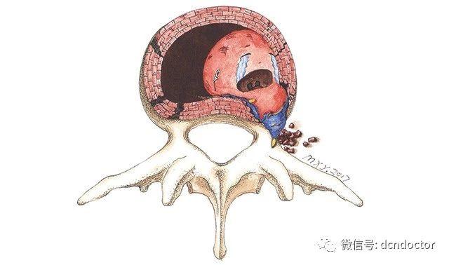 腰椎间盘突出有触电的感觉,腰椎间盘突出伤到神经怎么治疗