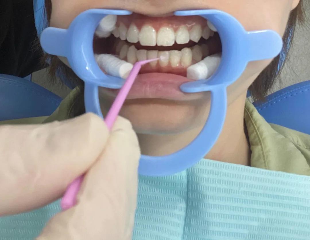 冷光美白牙齿危害亲身经历,牙齿美白科普篇