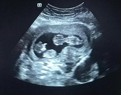 早孕检查是抽血好还是做b超好,早孕期检查都正常但还是出血