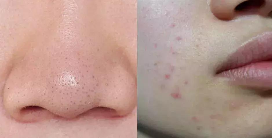 洗脸清洗黑头,洗脸清洁去粉刺