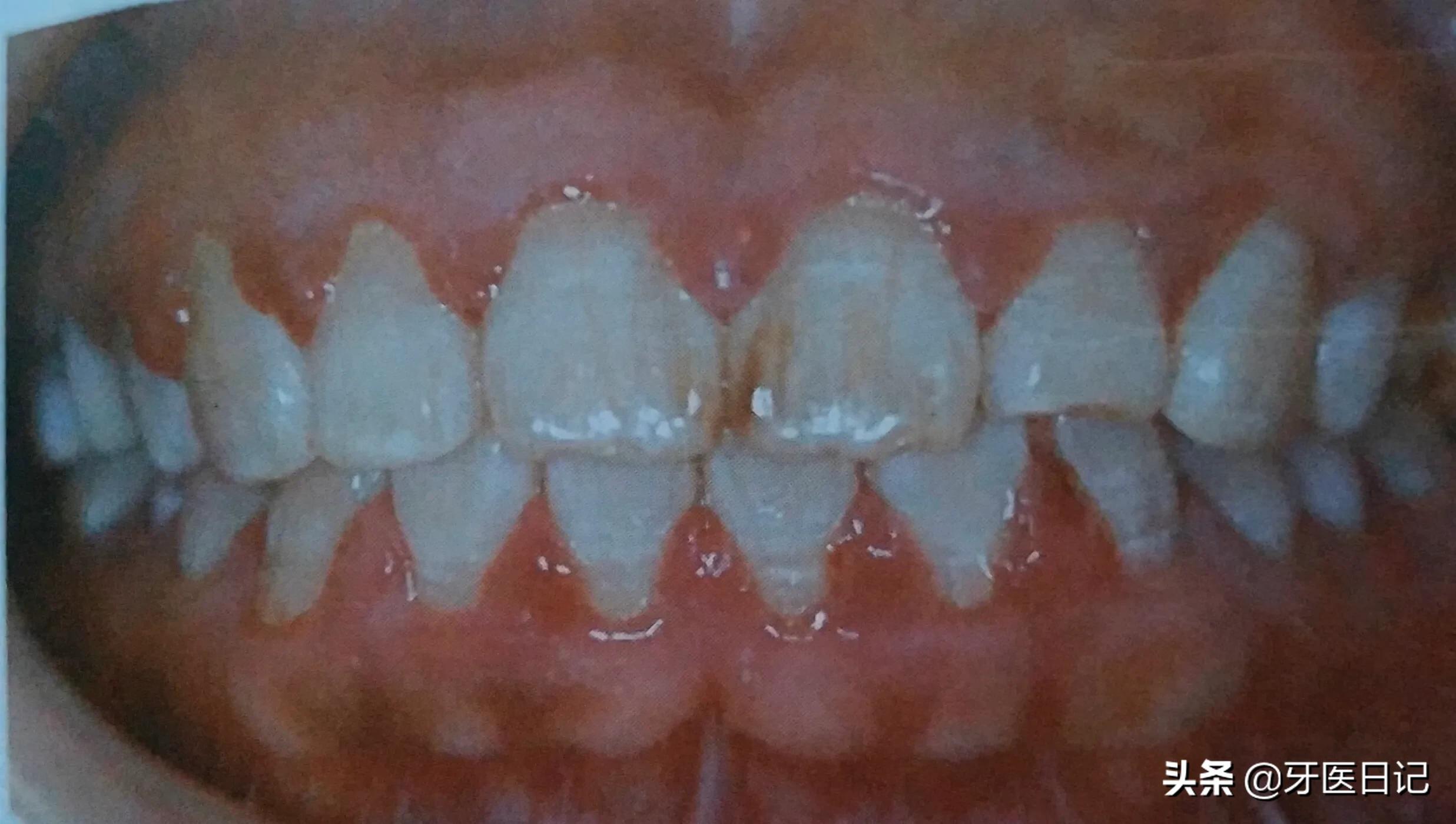 牙龈又红又肿，上火了吗？