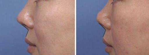 韦敏整形价格,九院韦敏聊整形