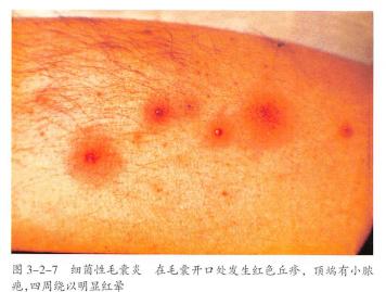 前胸后背的痘疤怎么去除,前胸后背长痘涂什么药膏