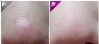 从科学角度看黑头能快速根除吗,重度黑头怎样彻底去除