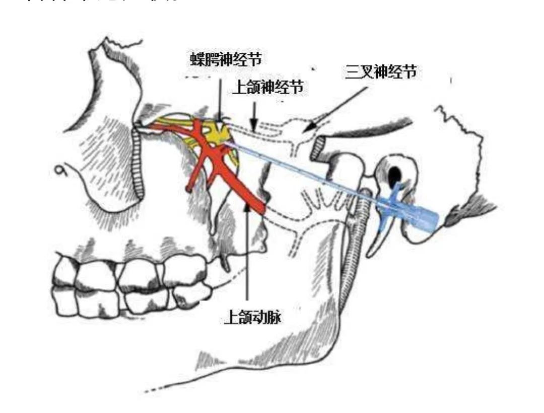 过敏性鼻炎引起的疼痛怎么缓解,过敏性鼻炎难受时怎么能缓解