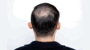 熬夜引起严重脱发还可以挽回吗,熬夜脱发男性型脱发能恢复吗