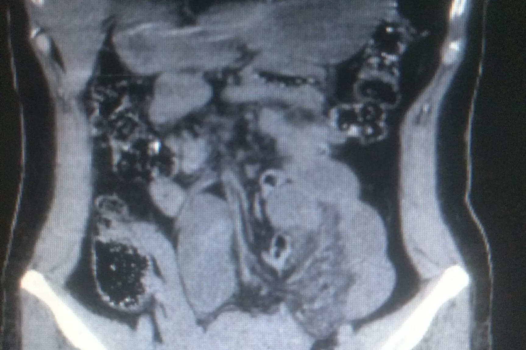 左下腹隐痛是尿道结石吗,右下腹疼痛是不是胆囊结石