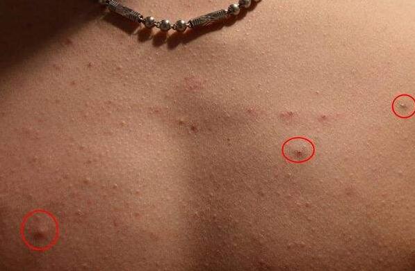 12岁女孩脸上和后背有痘痘怎么办,后背长小疙瘩一抠就掉