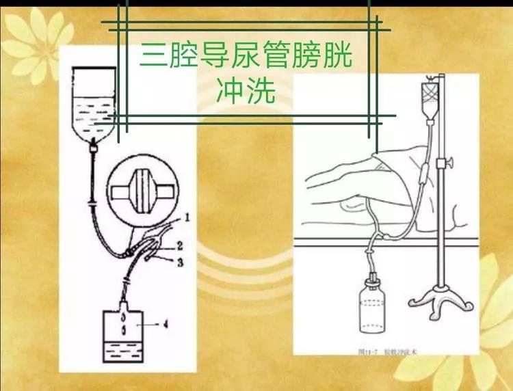 膀胱有肿瘤一定是癌症吗,通俗易懂讲解膀胱肿瘤