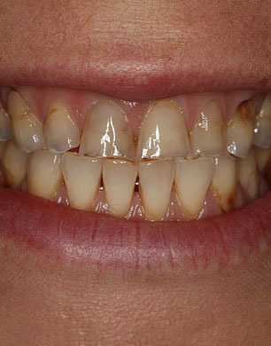 长期过度饮酒对牙齿的危害,长期吸烟喝酒的牙齿长什么样子