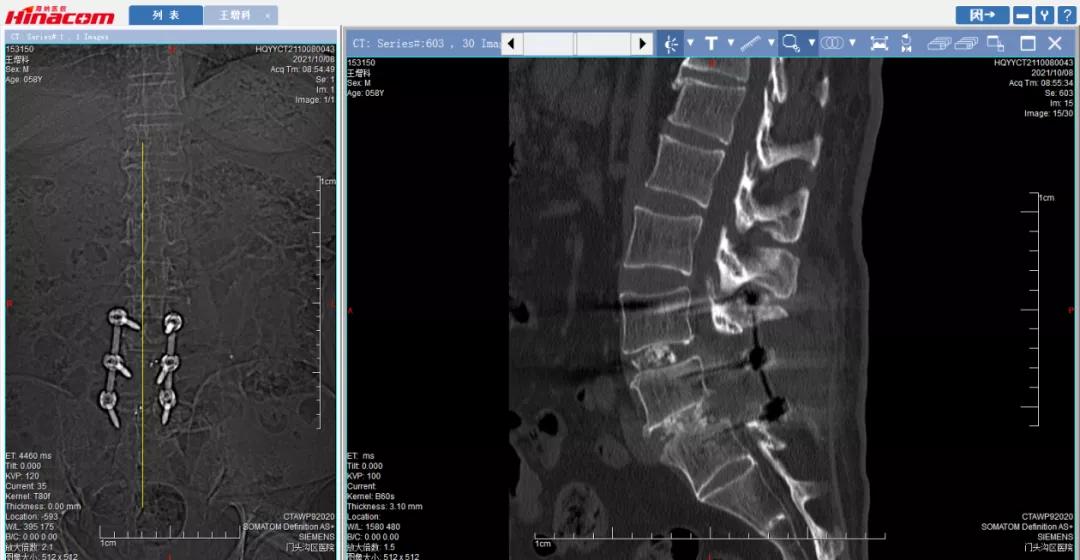 再也不用歪着身子走路了—区医院脊柱中心（骨二科）成功实施腰椎间盘摘除、椎间植骨融合钉棒内固定术