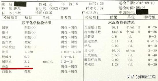 尿蛋白2+隐血3+白细胞3+严重吗,尿潜血3+白细胞3+怎么回事