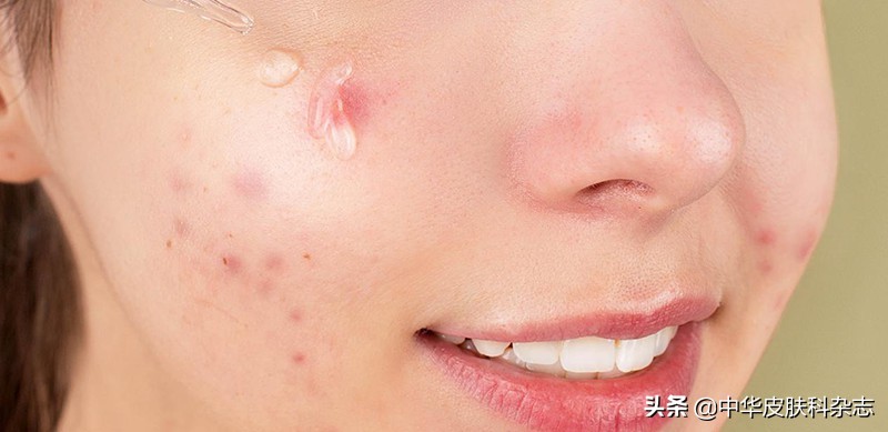 祛除痘疤痘印最好的产品,修复痘印痘坑痘疤的产品