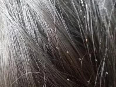 头发上的阴虱,阴虱长在头发上怎么处理