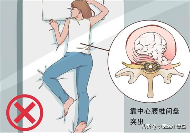 腰间盘突出的康复治疗,腰间盘突出的康复治疗有哪些