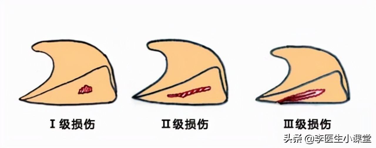 半月板损伤用什么样的膝关节支具,半月板损伤膝关节炎怎么治疗