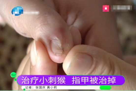8岁男童治疗刺猴，遵医嘱后却甲床坏死，竟是内科医生治疗外科病