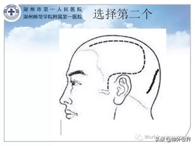 头皮裂伤缝合手术切口分类,头皮切口