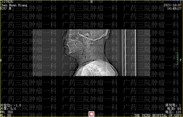 广药三院肿瘤治疗中心怎么样,广药三院肿瘤