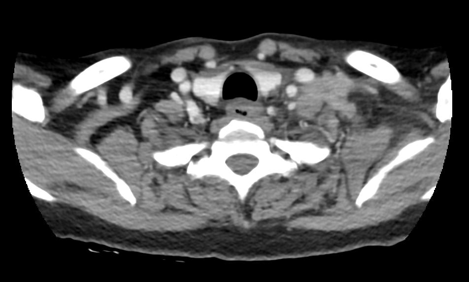 胰腺癌胃痛是什么情况,胃痛和胰腺炎区别与图片