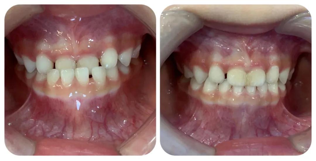 儿童牙咬合不正几岁矫正,儿童上牙反咬合正畸吃不了东西