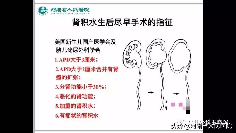 肾积水手术需要插几天尿管,宝宝重度肾积水