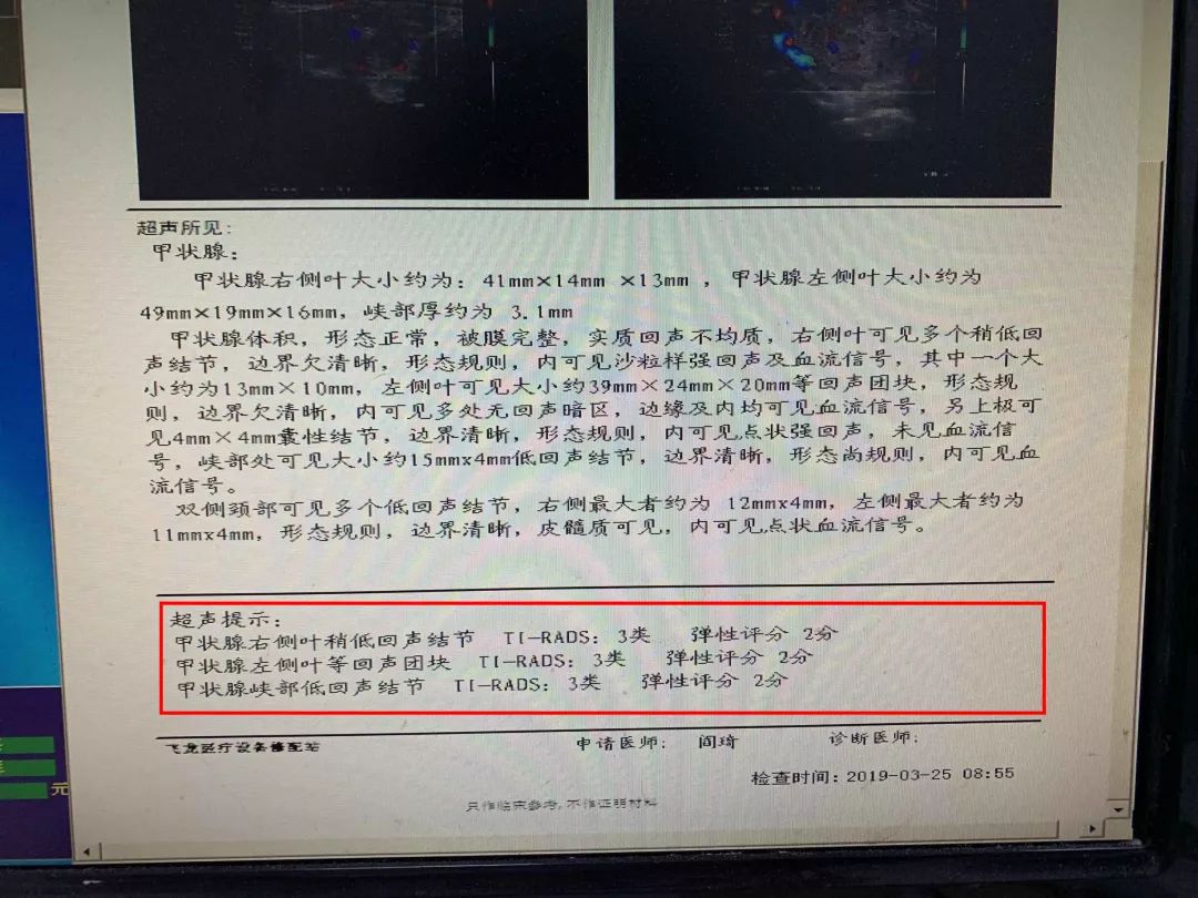 看懂化验单判断甲状腺结节良恶性,甲状腺结节微创和开刀的区别