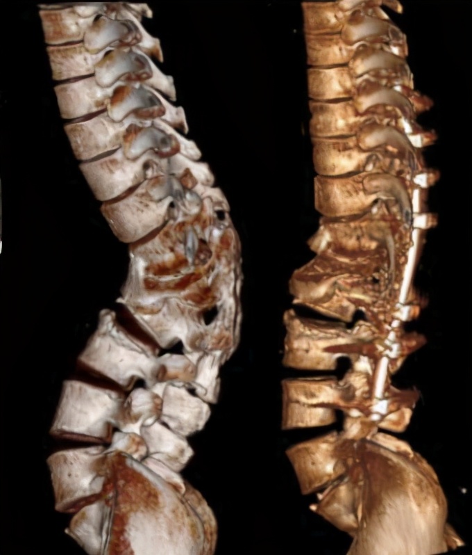 脊柱后凸处理方法,脊柱后凸最佳治疗方法