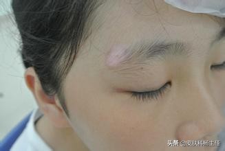 白癜风色素移植会有并发症吗,小朋友得了白癜风有什么并发症