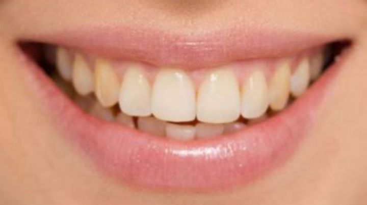 十八岁是矫正牙齿好还是烤瓷牙好,牙齿中线不齐能通过烤瓷牙修复吗