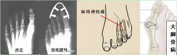 为了美,你愿意上麻药穿红色高跟鞋吗?