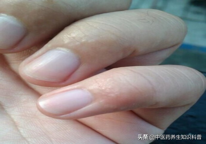 汗疱疹反复发作,怎么办?医生教你几招,帮你舒舒服服过夏天