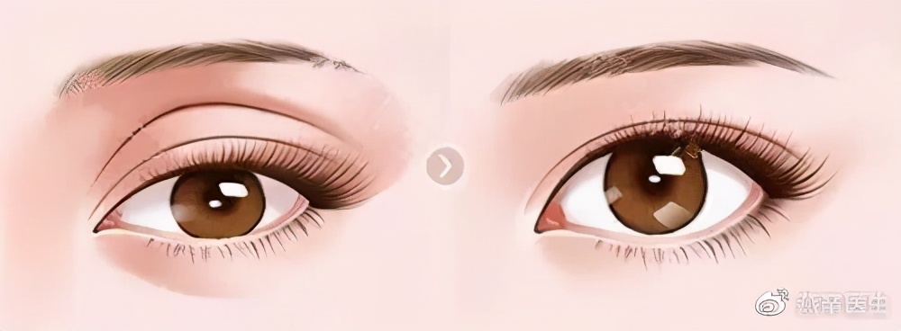 双眼皮修复科普,双眼皮修复要避免哪些坑