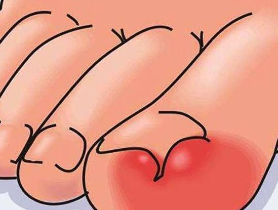 指甲长在了肉里修脚店可以处理吗,指甲嵌入肉了自己剪掉没关系不