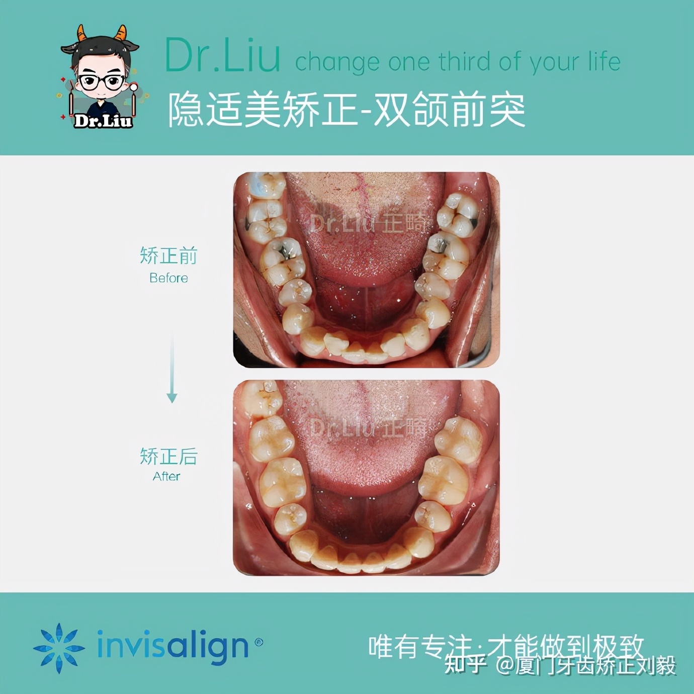 厦门成年人牙齿舌侧矫正,下嘴唇厚且外翻牙齿矫正