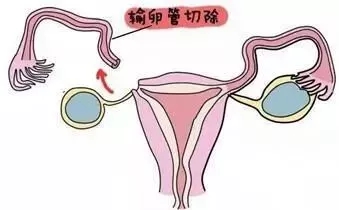 切除一侧输卵管后备孕一年没怀上,宫外孕切除一侧输卵管多久能备孕